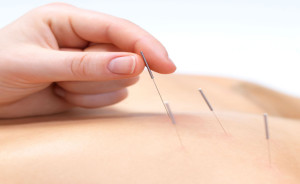 Acupunctuur naalden Behandelingsmethoden